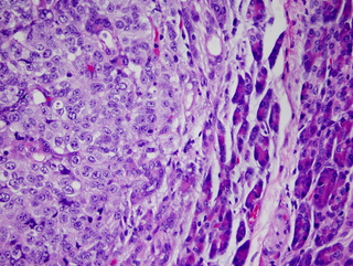 Illustration for article titled Cancer is just as deadly as it was 50 years ago. Here's why that's about to change.